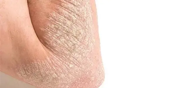 Skin Symptoms of Vitamin D Deficiency