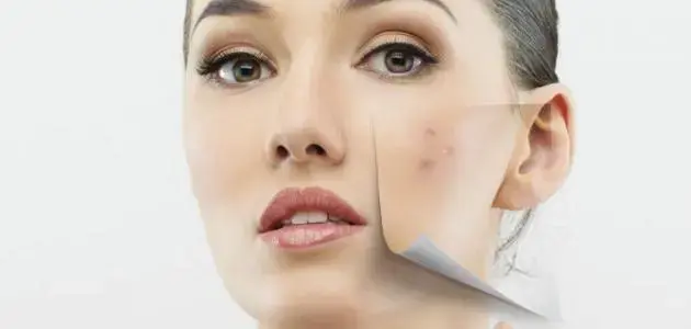 Does Vitamin D Deficiency Cause Facial Acne?