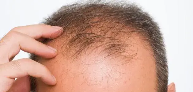 Vitamins to Help Prevent Hair Loss