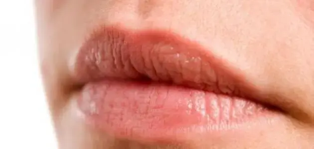 Dry Lips and Vitamin Deficiency